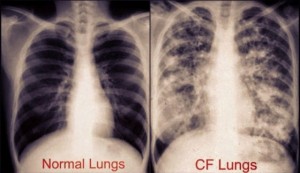 cf-lungs
